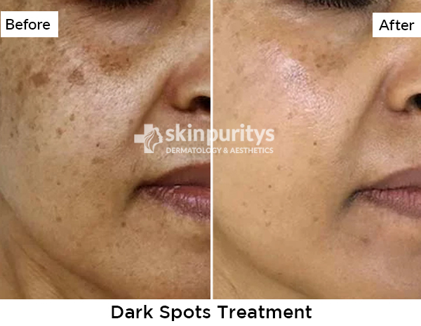 Dark Spots results